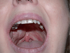 Опухоль из малых слюнных желез с локализацией в полости рта